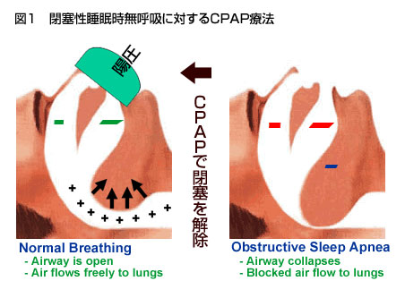 CPAP治療のイメージイラスト